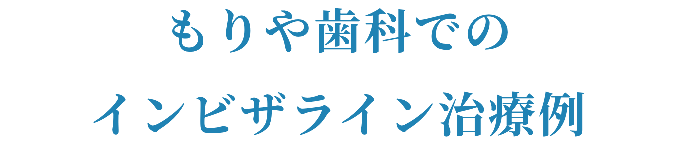 もりや歯科のインビザライン治療例