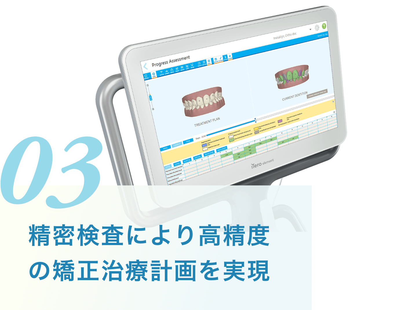 精密検査により高精度の矯正治療計画を実現